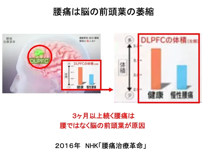 腰痛は脳の前頭葉の萎縮