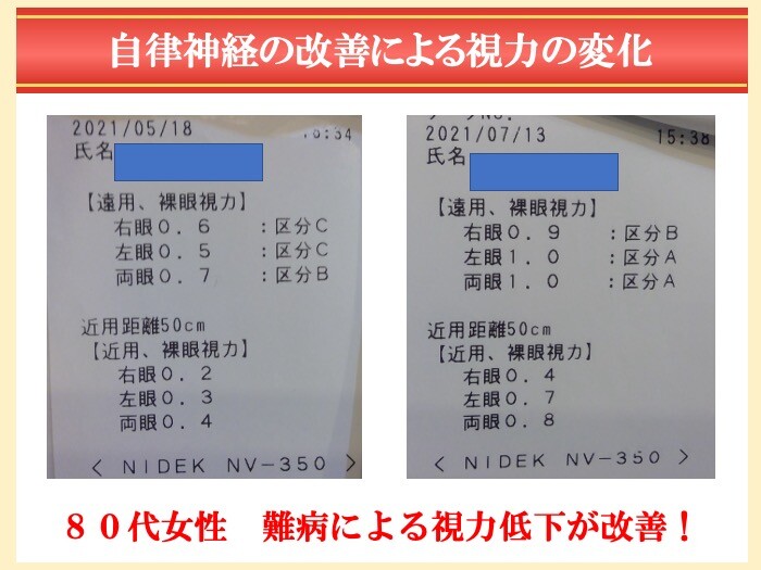 ８０代女性難病による視力低下が改善した例