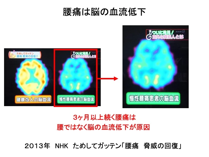 腰痛は脳の血流低下