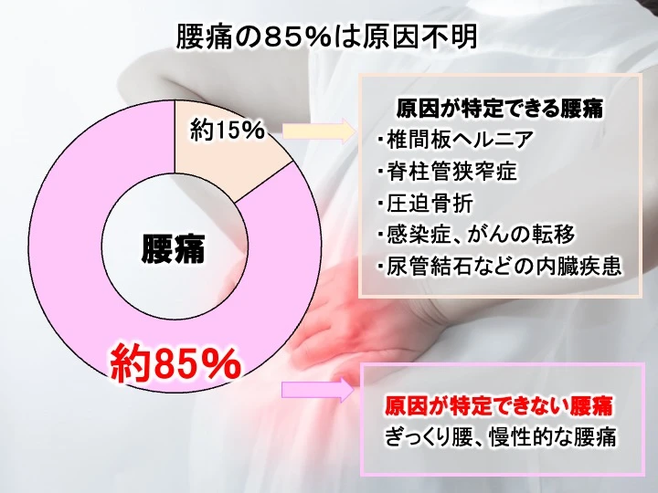 腰痛の85％は原因不明であることを表した画像